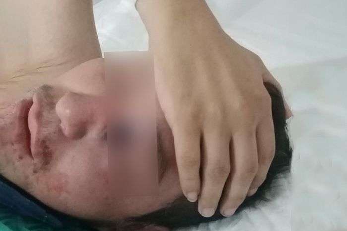 Muere Gregorio; el primer caso de hongo negro en México