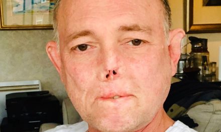 Doctor pierde sus piernas, dedos y parte de su rostro por la lamida de su perro
