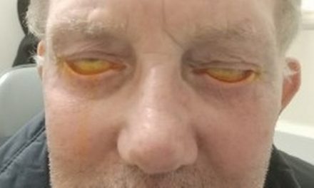 Hombre se somete a cirugía, cumple 3 años sin poder cerrar los ojos
