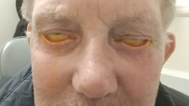 Hombre se somete a cirugía, cumple 3 años sin poder cerrar los ojos