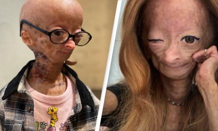 Fallece a los 15 años youtuber con rara enfermedad de envejecimiento acelerado ‘Benjamin Button’