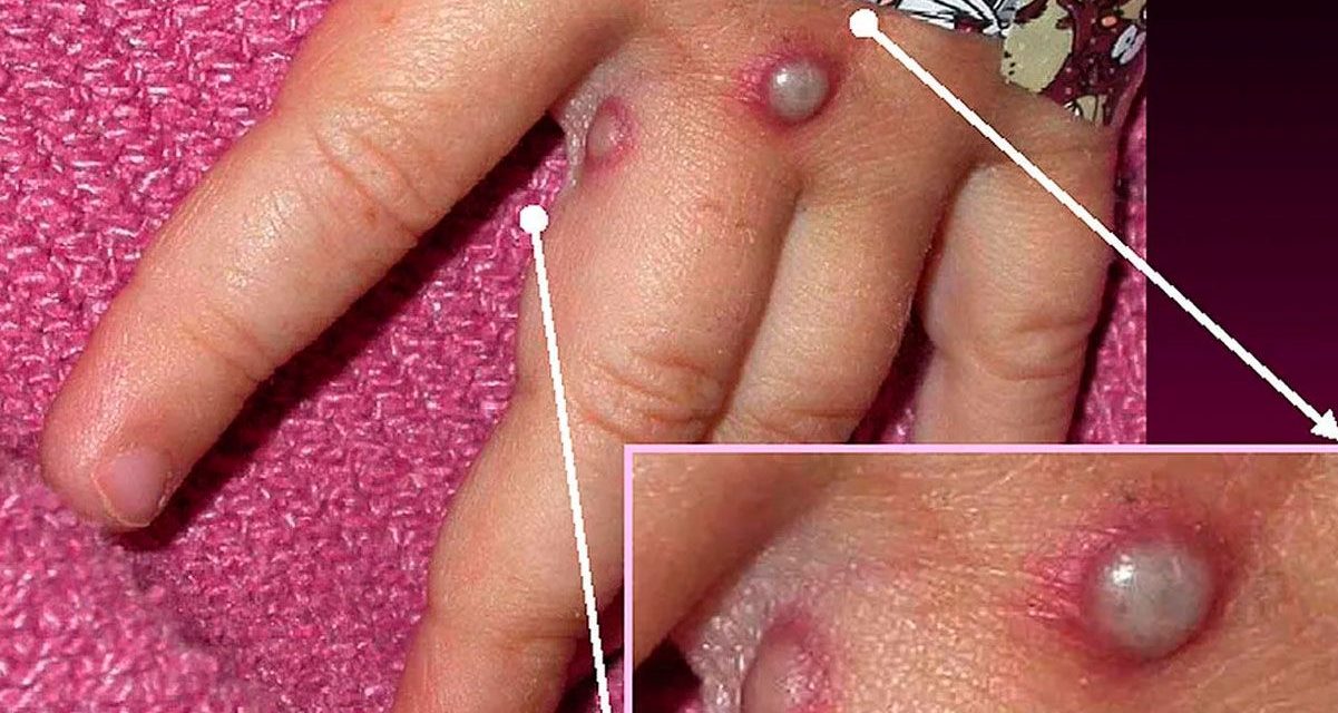 ¿Qué es y como afecta al ser humano la viruela del mono?
