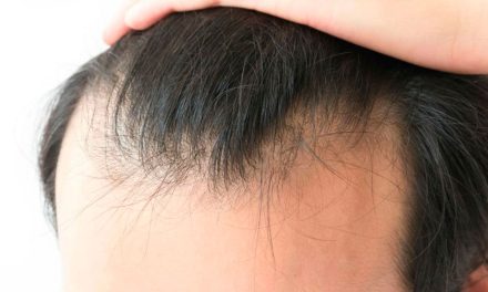 Adiós calvicie; aprueban medicamento contra alopecia que restaura crecimiento del cabello