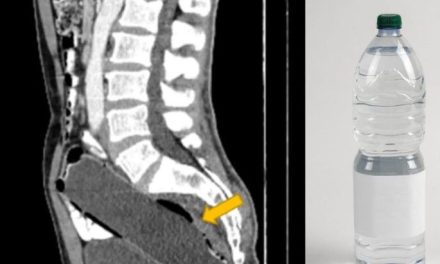 Hombre no podía ir al baño… pensó que estaba estreñido pero le encontraron una botella en el intestino