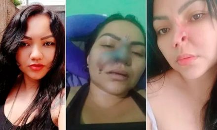 Contrata a dentista en internet para operarse nariz y le desfigura el rostro