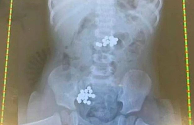 Niña muere en Saltillo por ‘comer’ imanes… la Pronnif ya investiga