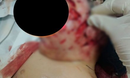 Imagen fuerte: Niña de 1 año es atacada por perros y le desfiguran el rostro en el Edomex