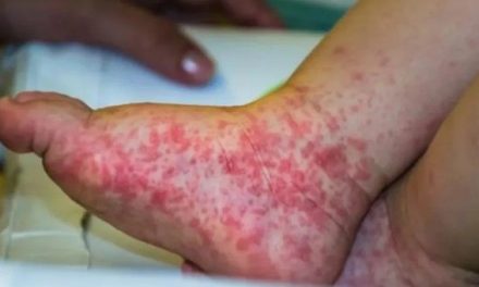 Esta es la gripe del tomate; la nueva enfermedad que afecta a los niños