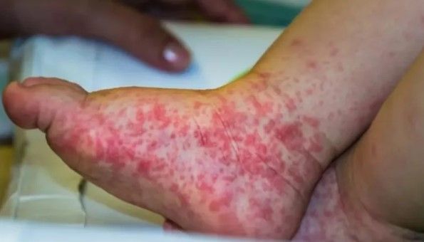 Esta es la gripe del tomate; la nueva enfermedad que afecta a los niños