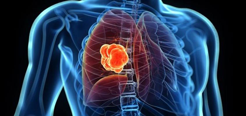 Científicos hallan una posible cura contra el cáncer de pulmón