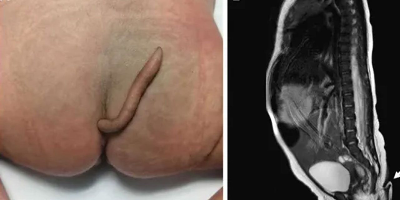 Reportan nacimiento de una bebé con cola de 6 centímetros en Nuevo León