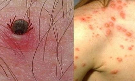 Confirman 24 casos de fiebre manchada; Saltillo foco rojo