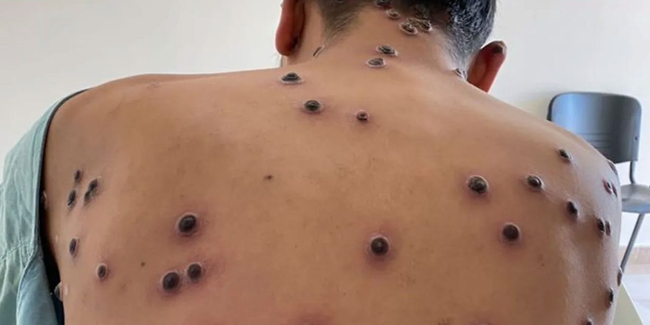 Mpox; OMS cambia el nombre de la viruela del mono