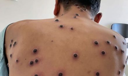 Mpox; OMS cambia el nombre de la viruela del mono