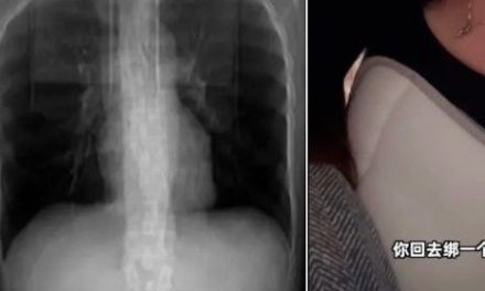 Mujer tose muy fuerte y ‘se rompe’ por dentro… se fracturó cuatro costillas