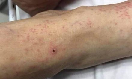 29 casos de Rickettsia en Coahuila; mueren 20 en 2022