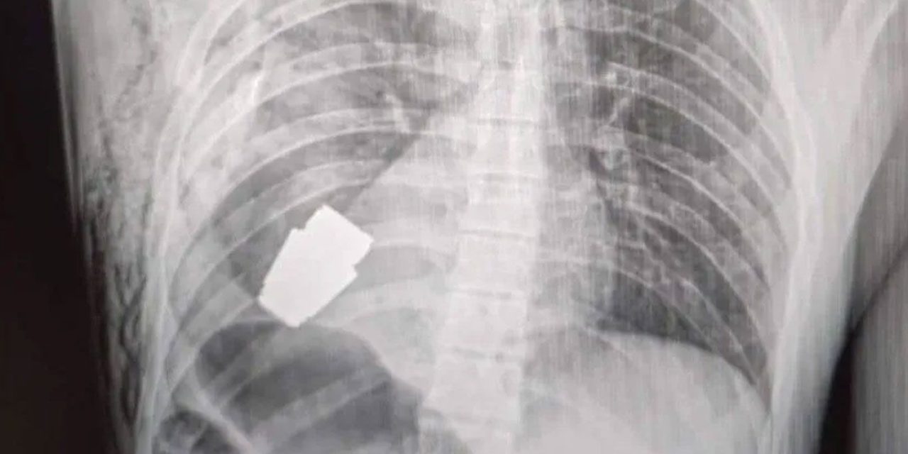 Someten a cirugía a soldado ucraniano para quitarle granada activa del torso
