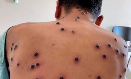 México está cerca de alcanzar los 4 mil casos de viruela del mono o ‘Mpox’
