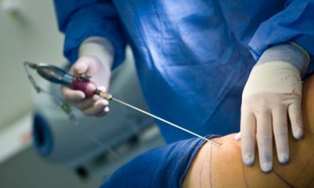 Mujer afirma que tiene cáncer; recauda dinero y lo utiliza para hacerse una liposucción