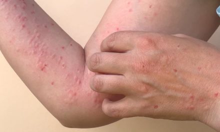 OMS declara fin de la emergencia sanitaria por la viruela del mono
