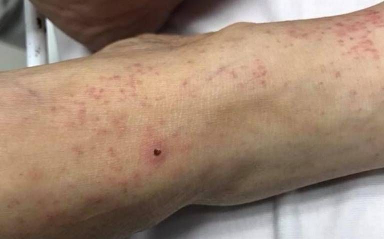 Rickettsia termina con una familia de San Pedro