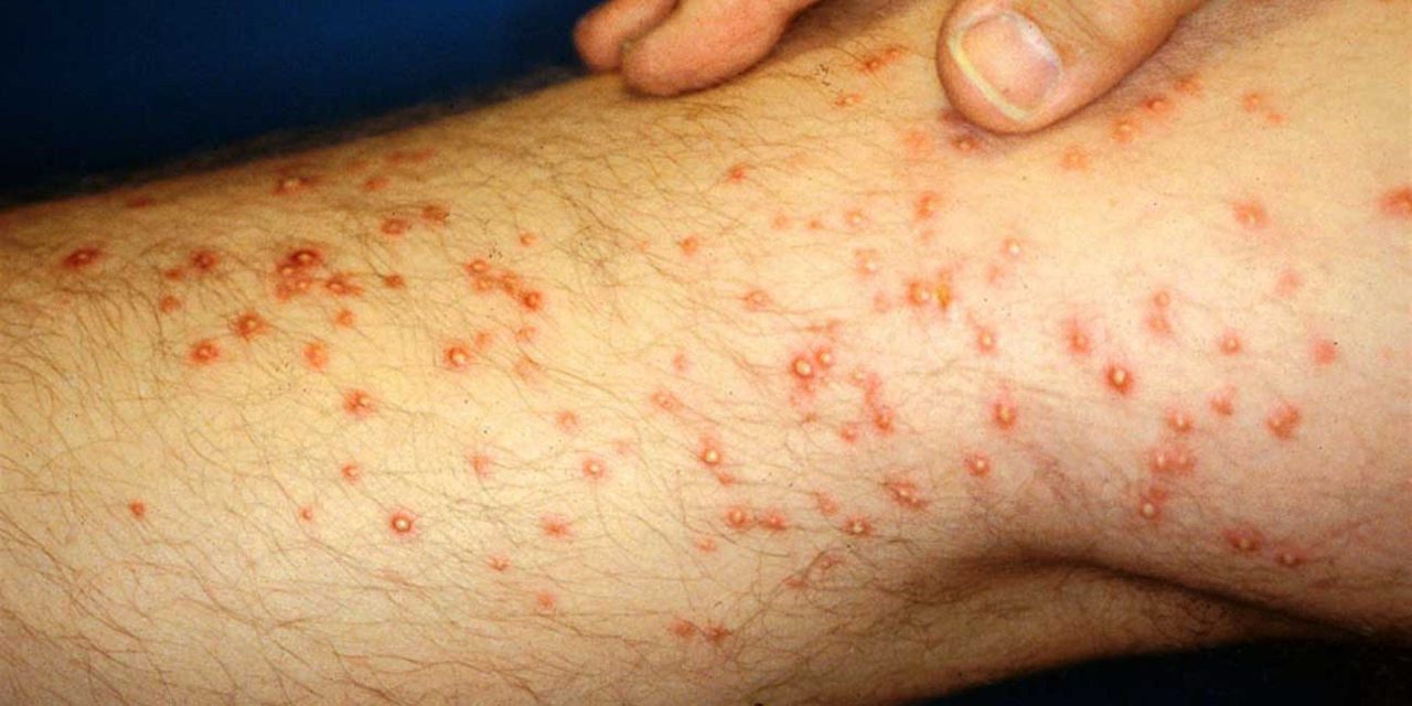 Suman 17 decesos por fiebre manchada en Coahuila