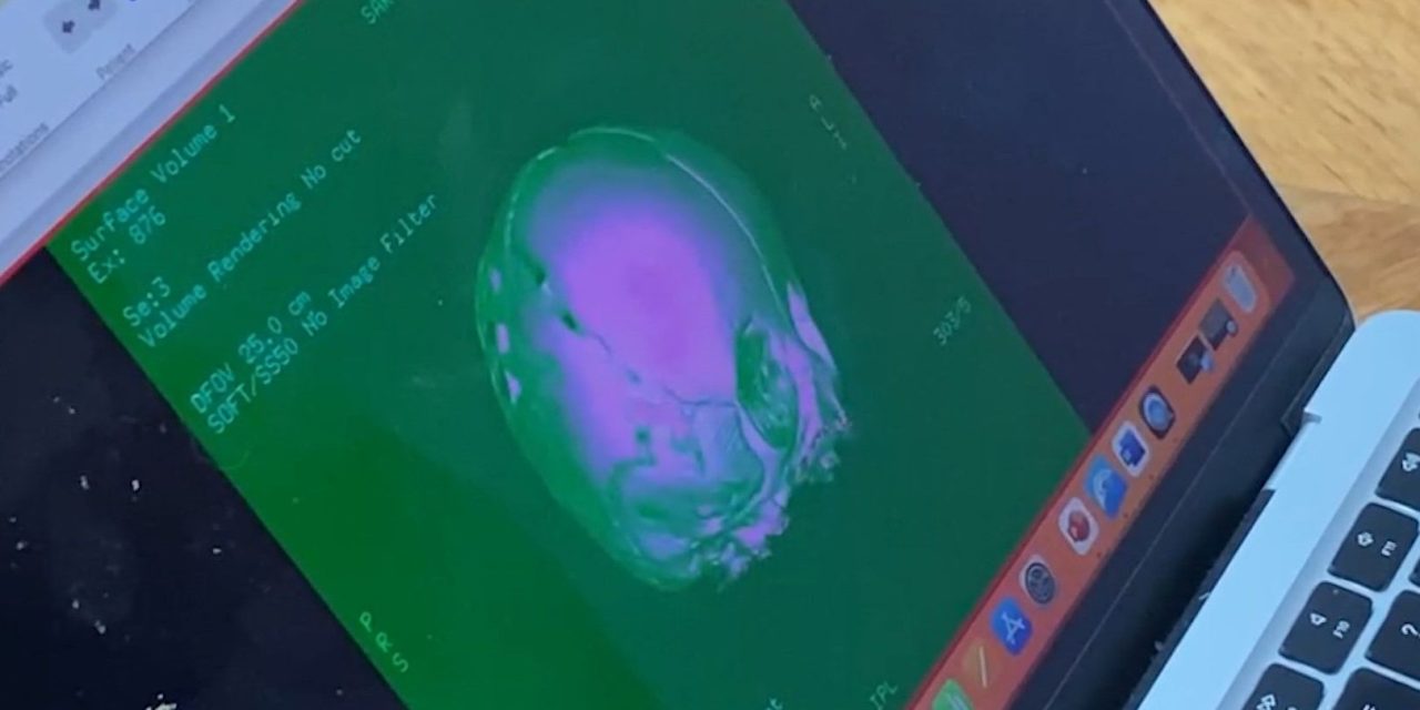 Realiza hospital materno infantil primera cirugía de reconstrucción de cráneo