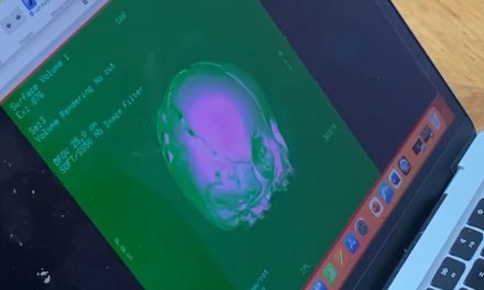 Realiza hospital materno infantil primera cirugía de reconstrucción de cráneo