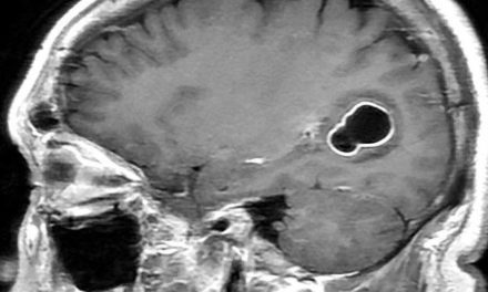 Chip integrado con IA permite a un paciente con parálisis cerebral comunicarse en inglés y en español