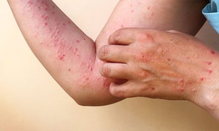 La OMS alerta sobre nueva cepa del mpox y su impacto global