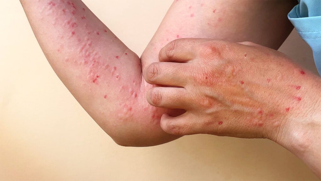 La OMS alerta sobre nueva cepa del mpox y su impacto global