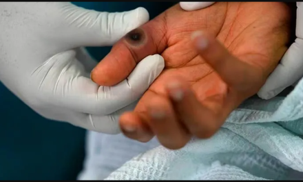 La OMS advierte sobre posibles brotes de Mpox en Europa tras detectar una variante en Suecia