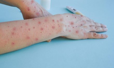 Nuevo aumento de casos de viruela símica en México, hay 72 contagios