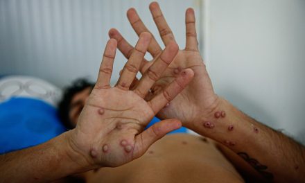 México registra 84 casos de viruela del mono en 2024: OMS declara emergencia de salud pública