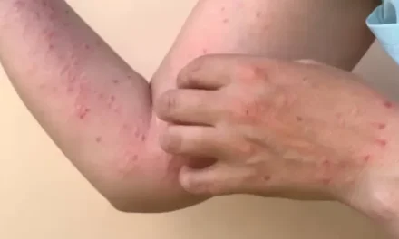 México en alerta sanitaria por brote de sarampión en las 32 entidades del país