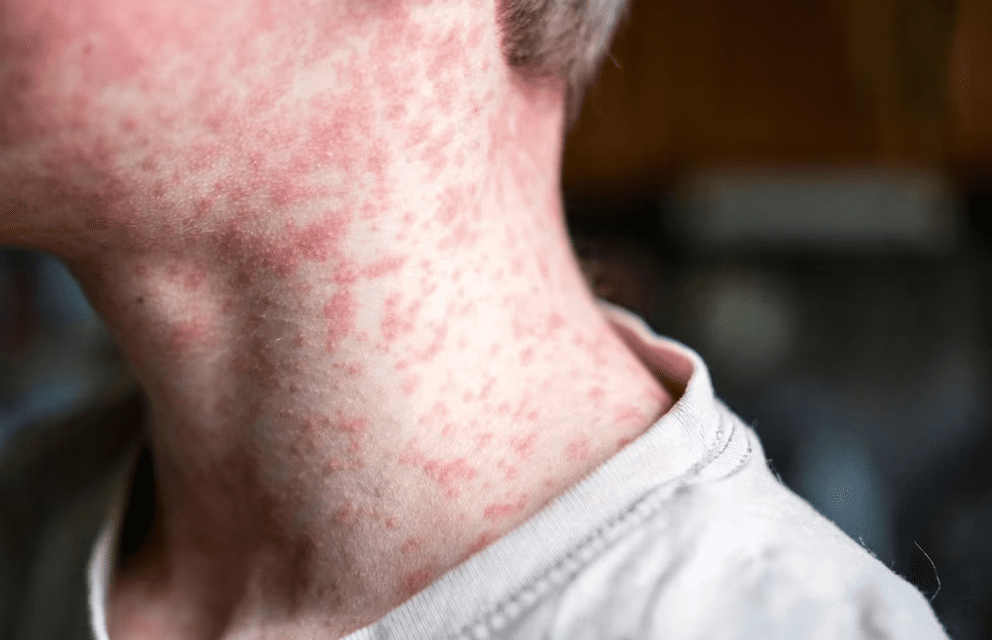Al alza los contagios de sarampión en México