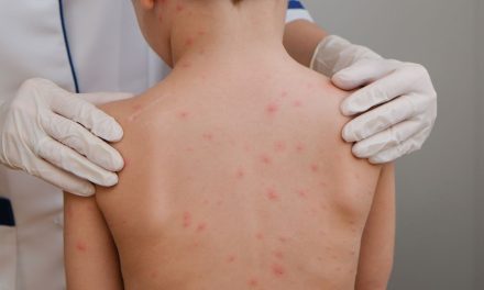 Se mantiene activa la alerta por sarampión en México